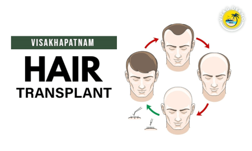 Hair-Transplant-Center-in-Vizag